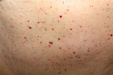 Derrick Bradley Rumor Tiny Red Dots On Skin From Sun