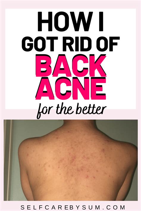 How To Get Rid Of Back Acne For Better Sbs Acne Wash Clinique Acne