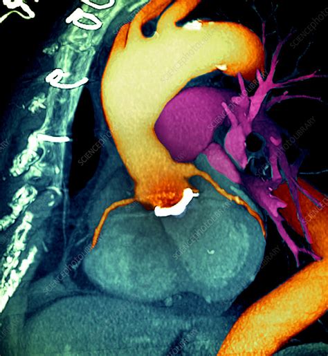 Prosthetic Heart Valve 3d Ct Scan Stock Image M5600590 Science