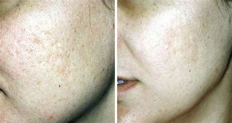 Microdermabrasion And Sonophoresis For Complete Skin Rejuvenation Beautiphi