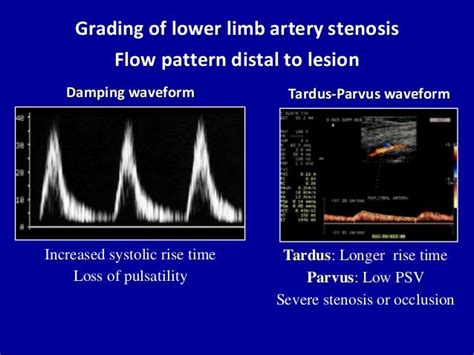 Normal Arterial Doppler Lower Extremity