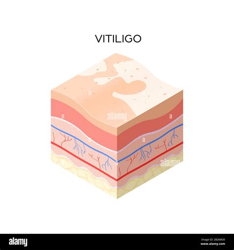 Vitiligo Skin Cross Section Of Human Skin Layers Structure Skincare