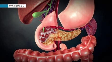 하.지.만 현재 사망률이 약 1%라는 췌장암 수술이 있습니다~ 플러스! 췌장암 환자 수술 사례 2 - YouTube