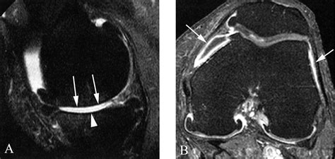 Synovitis In Knee Osteoarthritis Assessed By Contrast Enhanced Magnetic