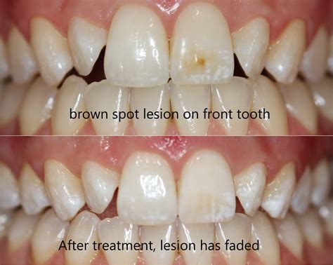 How To Get Rid Of Brown Spots On Teeth Donna Love