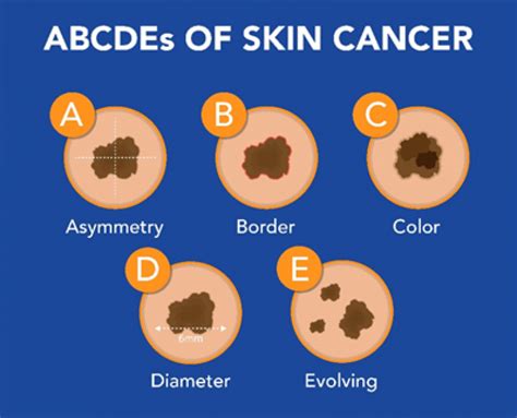 Treat Skin Cancer Advanced Dermatology And Skin Cancer Center Pllc