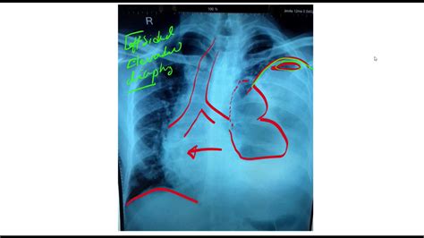 Elevated Hemi Diaphragm Chest X Ray Causes Paralysis Or Eventration