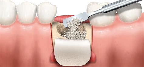 Bone Grafts • Kai Dental