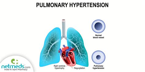 Pulmonary Hypertension Causes Symptoms And Treatment