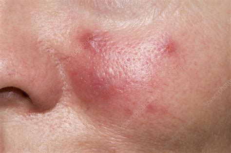 Acne Rosacea On The Cheek Stock Image C0085644 Science Photo Library