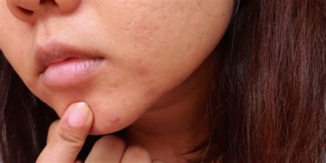 What To Know About Treating Cystic Acne Per Dermatologists Popsugar