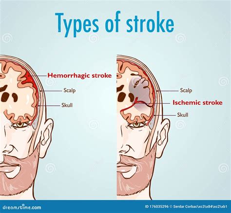 Vector Illustration Of A Hemorrhagic And Ischemic Stroke Stock Vector Illustration Of Artery