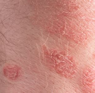 Pinprick red dots on skin not itchy pregnant. Red Patches on Skin, Itchy, Round, Raised, Face, Baby ...