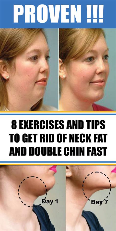 How To Get Rid Of Nape Fat Off 52