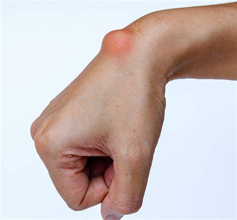Ganglion Cysts Symptoms Causes And Treatment Off