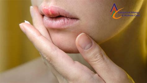 A Strong Overview About Hives On Lips By Advanced Allergy And Asthma
