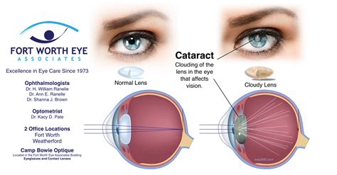 [get 30 ] Glasses For One Eye After Cataract Surgery