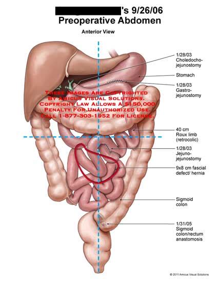 amicus illustration of amicus surgery abdomen bowel choledochojejunostomy stomach