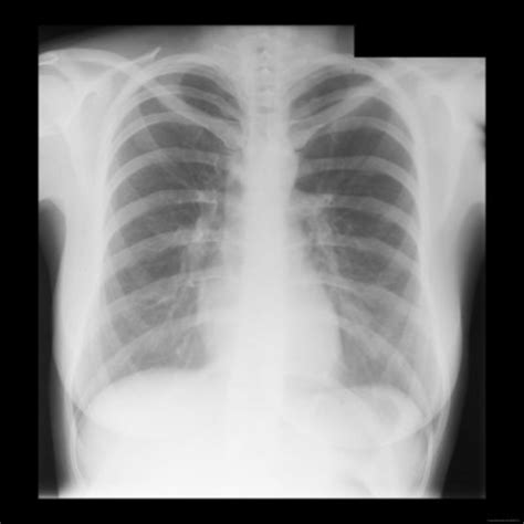 Reading The Chest X Ray Chest Radiography Identifying A Normal Chest