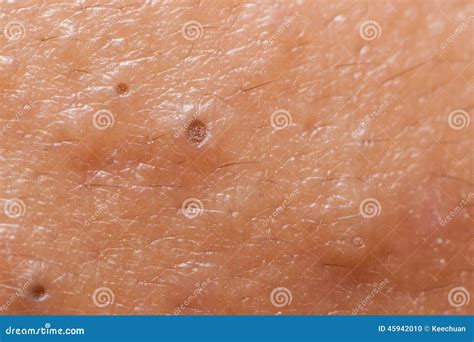 Closed Up Of Blackheads On Facial Skin Stock Photo Image Of Asian