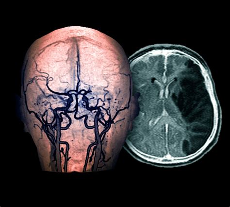 Ahaasa 2021 Guidelines For Secondary Stroke Prevention The