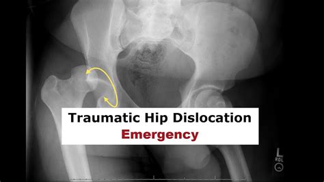 Traumatic Hip Dislocation Emergency Youtube