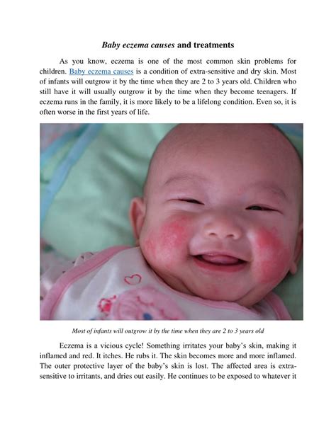 Ppt Baby Eczema Causes Powerpoint Presentation Free Download Id