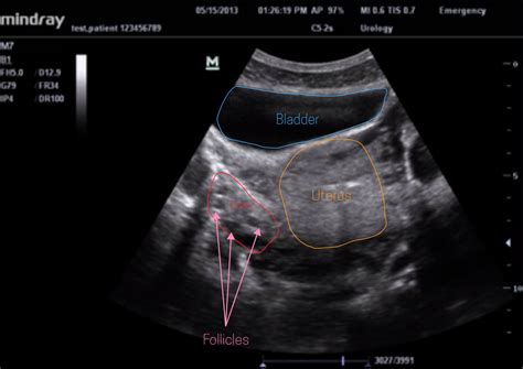 ultrasound leadership academy the basics of pelvic transabdominal ultrasound — em curious