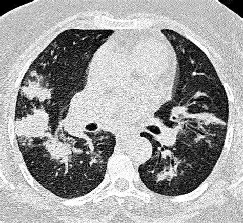 Bacterial Pneumonia Ct Scan Stock Image C0345689 Science Photo