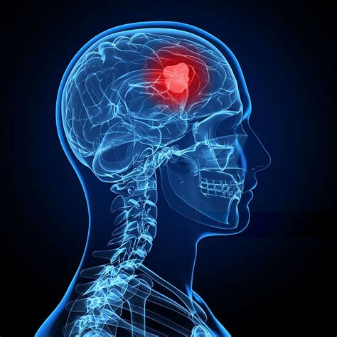 Brain Tumor Symptoms And Causes Healthzigzag