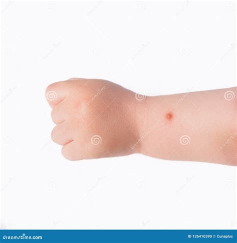 Mosquito Bite Stock Photo Image Of Scar Care People 126410390