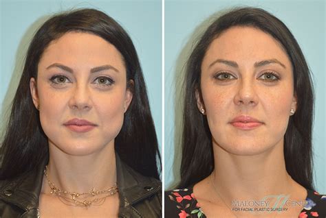 Before And After Buccal Fat Pad Removal Gallery Atlanta