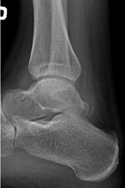 Lateral Radiograph Of The Ankle Obtained 6 Weeks After The Injury
