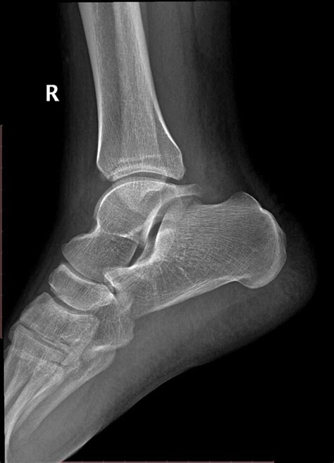Posterior Ankle Impingement Radiology Case