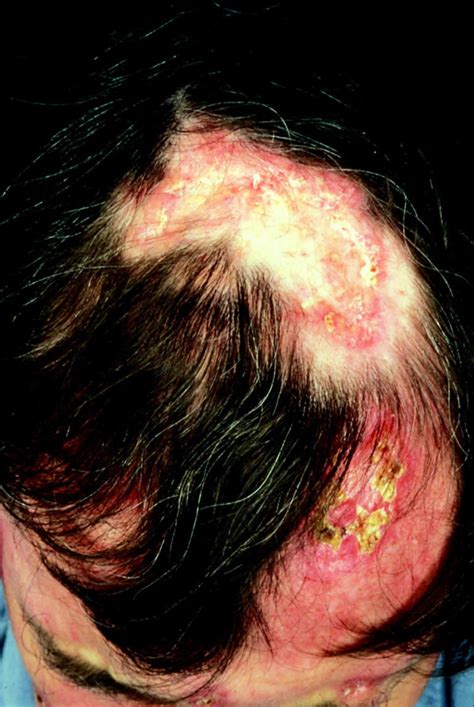 Discoid Lupus Erythematosus Causes Signs Symptoms Diagnosis And Treatment