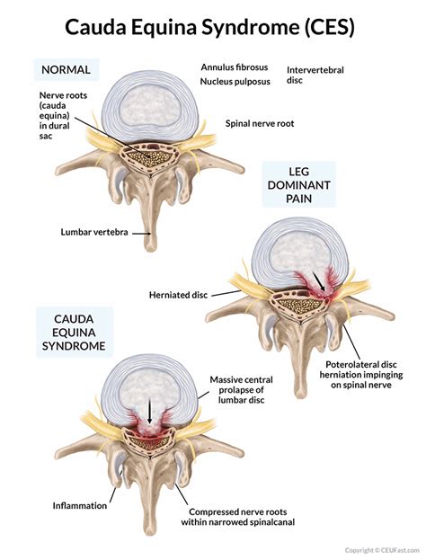 Spinal Cord Injuries Non Traumatic Nursing Ceu Aota Ceufast