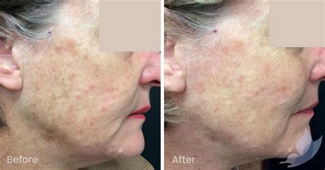 Freckles Age Spots And Sun Damage Before And After Gallery Austin Clinic