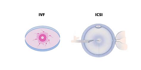 Ivf Vs Icsi Difference Between Ivf And Icsi Fertility World