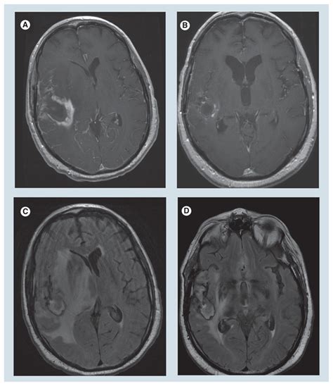 Mri Effects Of Decadron Axial Post Gadolinium T1 Images Ab And Axial