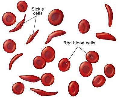 SICKLE CELL ANEMIA: WHAT IS SICKE CELL ANEMIA?