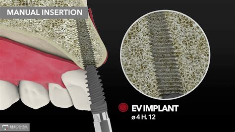 B B Dental Compactor Expander Protocol D3 D4 Bone EV Implant Line