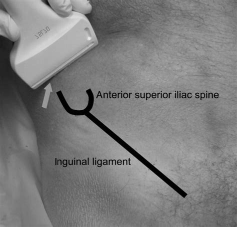 Ultrasound Guided Blocks Of The Ilioinguinal And Iliohypogastric Nerve