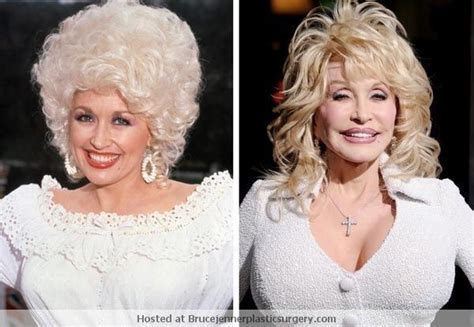 Dolly Parton Plastic Surgery Before and After #Dolly # ...