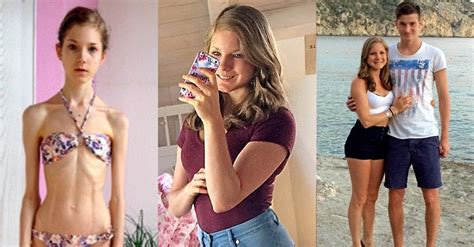 La Transformation Hallucinante D Une Anorexique De 22 Kilos