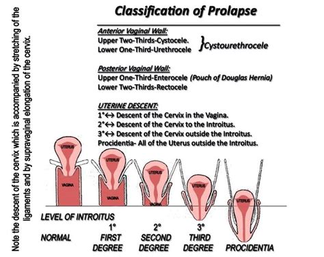 A Diagram Showing The Stages Of Prolapse And How To Use It For Treatment