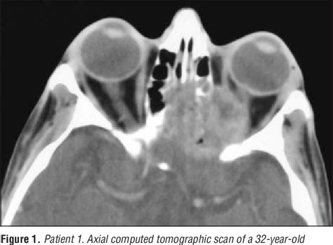 Figure 1 From Sino Orbital Aspergillosis In Acquired Immunodeficiency