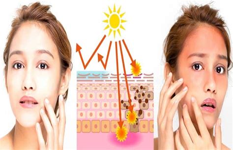 Sun Poisoning Treatment Types Symptoms And Prevention