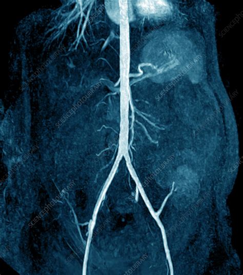 Transplanted Kidney Mri Scan Stock Image M1950131 Science Photo