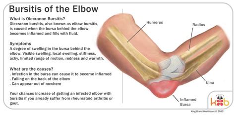 Elbow Bursitis Bursitis Elbow Bursitis Bursitis Treatment