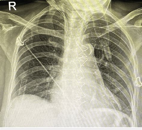 Postoperative Chest X Ray Showing No Recurrent Lesion Download